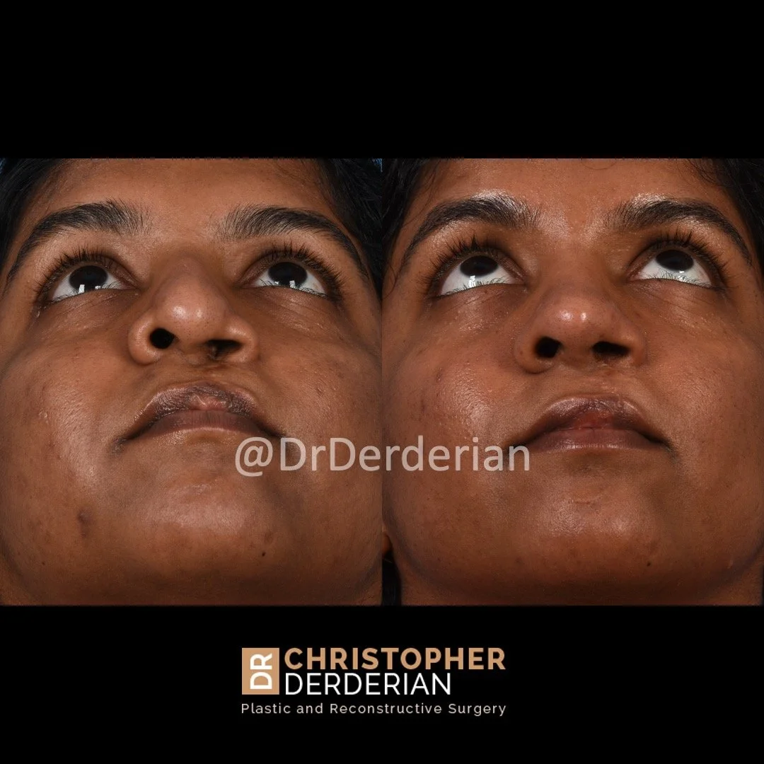 before and after cleft rhinoplasty and cleft lip revision case 13 below