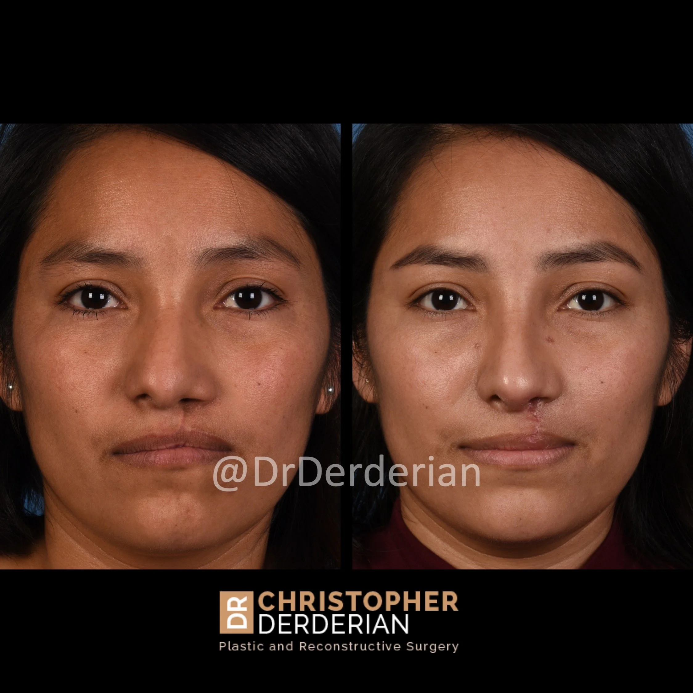 before and after cleft rhinoplasty and cleft lip repair case 14 AP