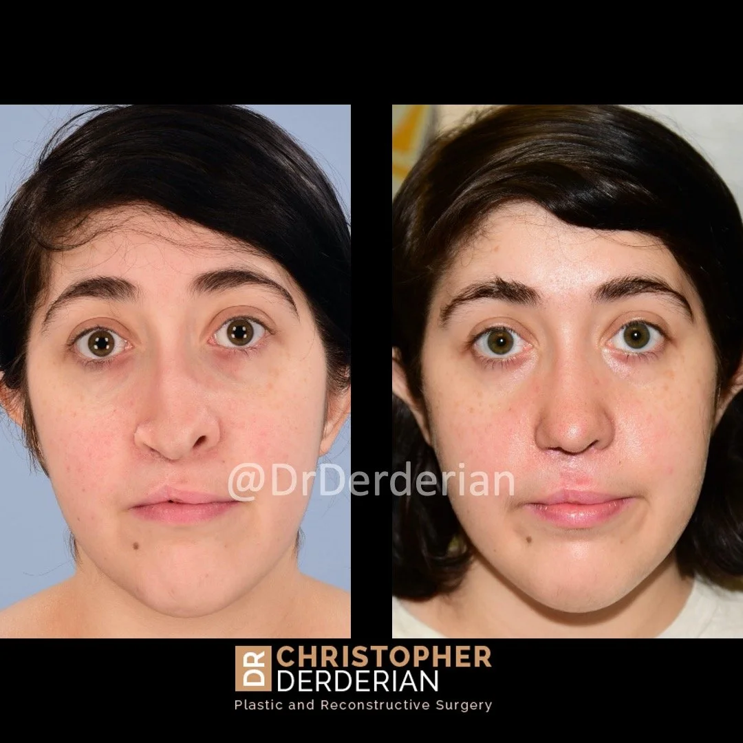 before and after cleft rhinoplasty and cleft lip revision case 16 AP