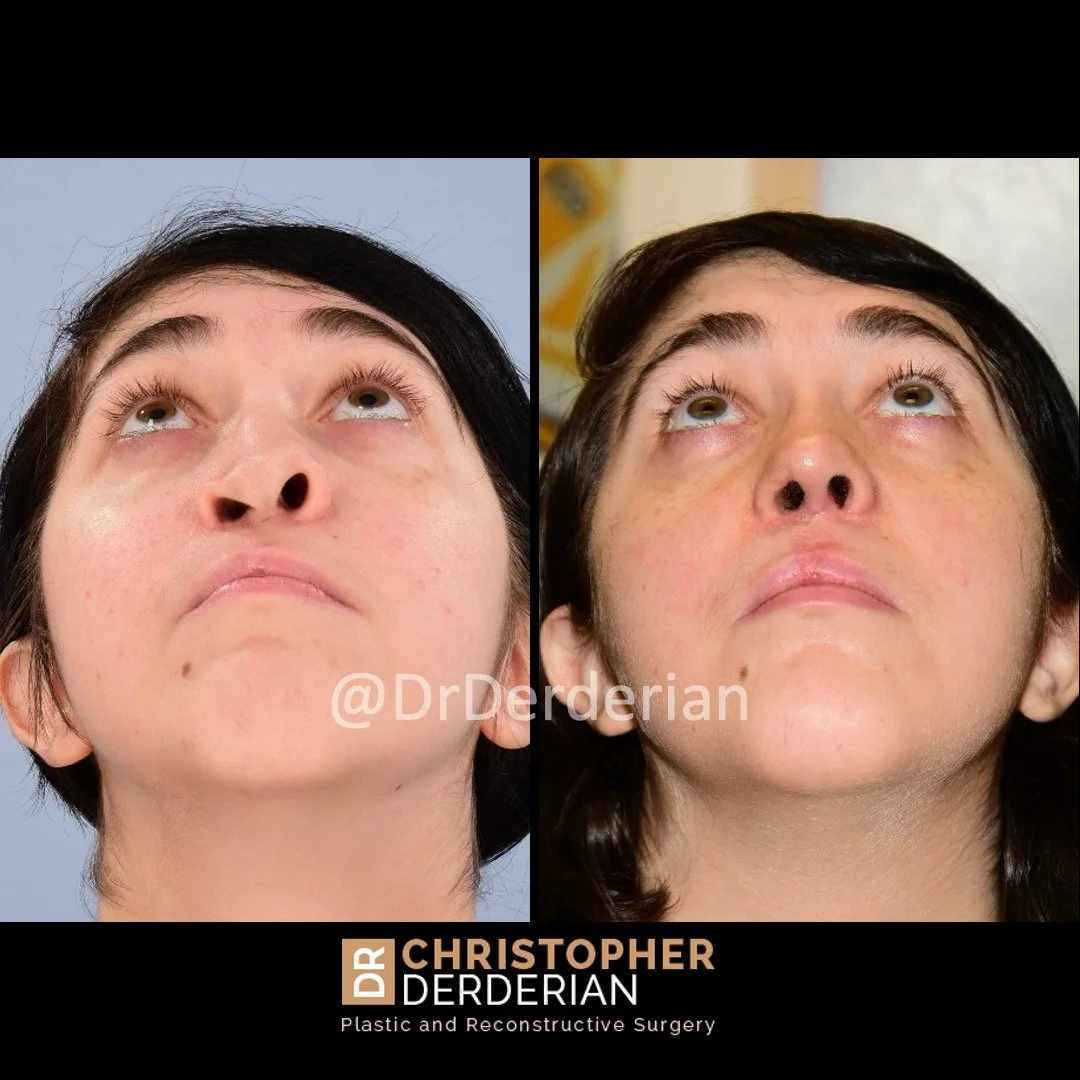before and after cleft rhinoplasty and cleft lip revision case 16 below view