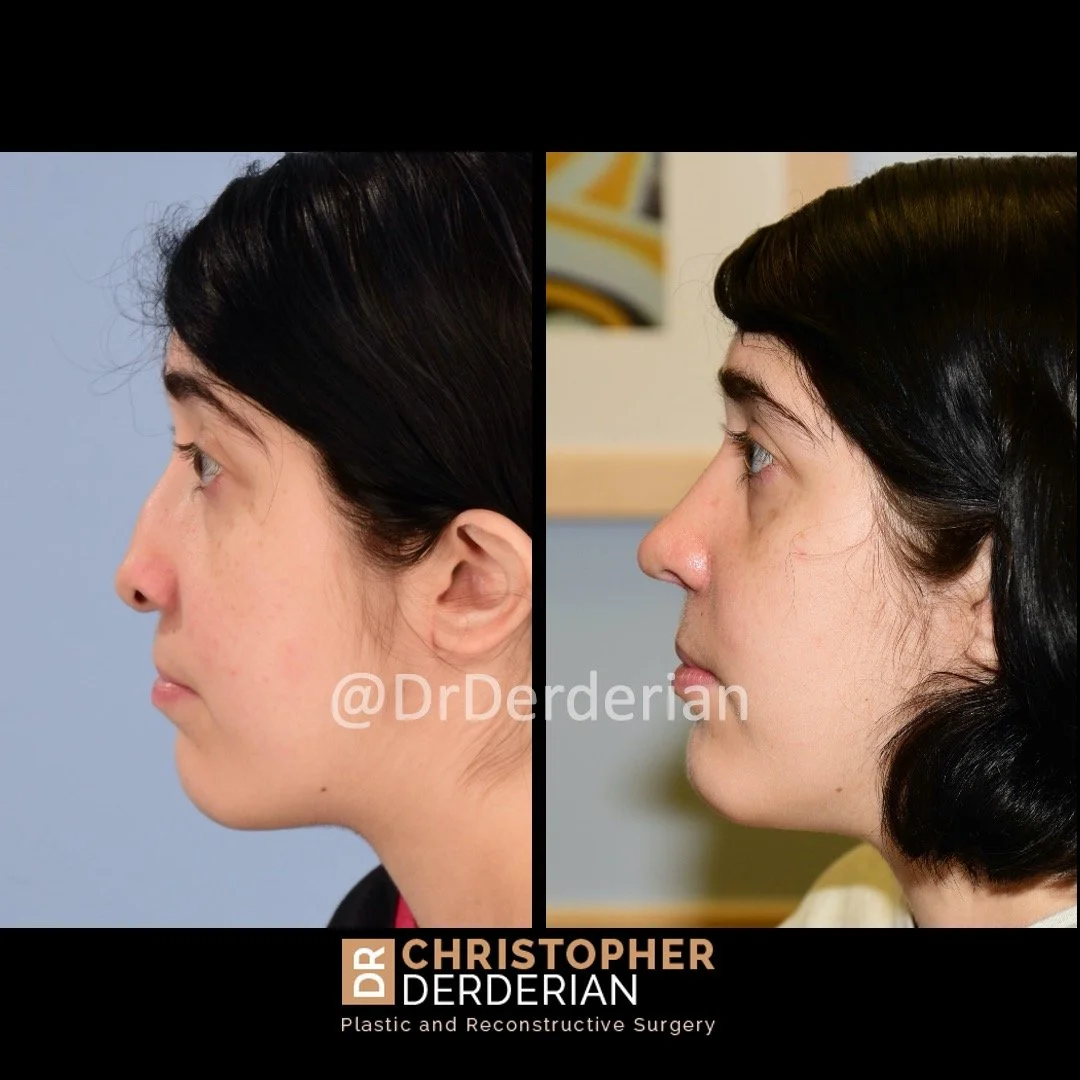 before and after cleft rhinoplasty and cleft lip revision case 16 left lateral
