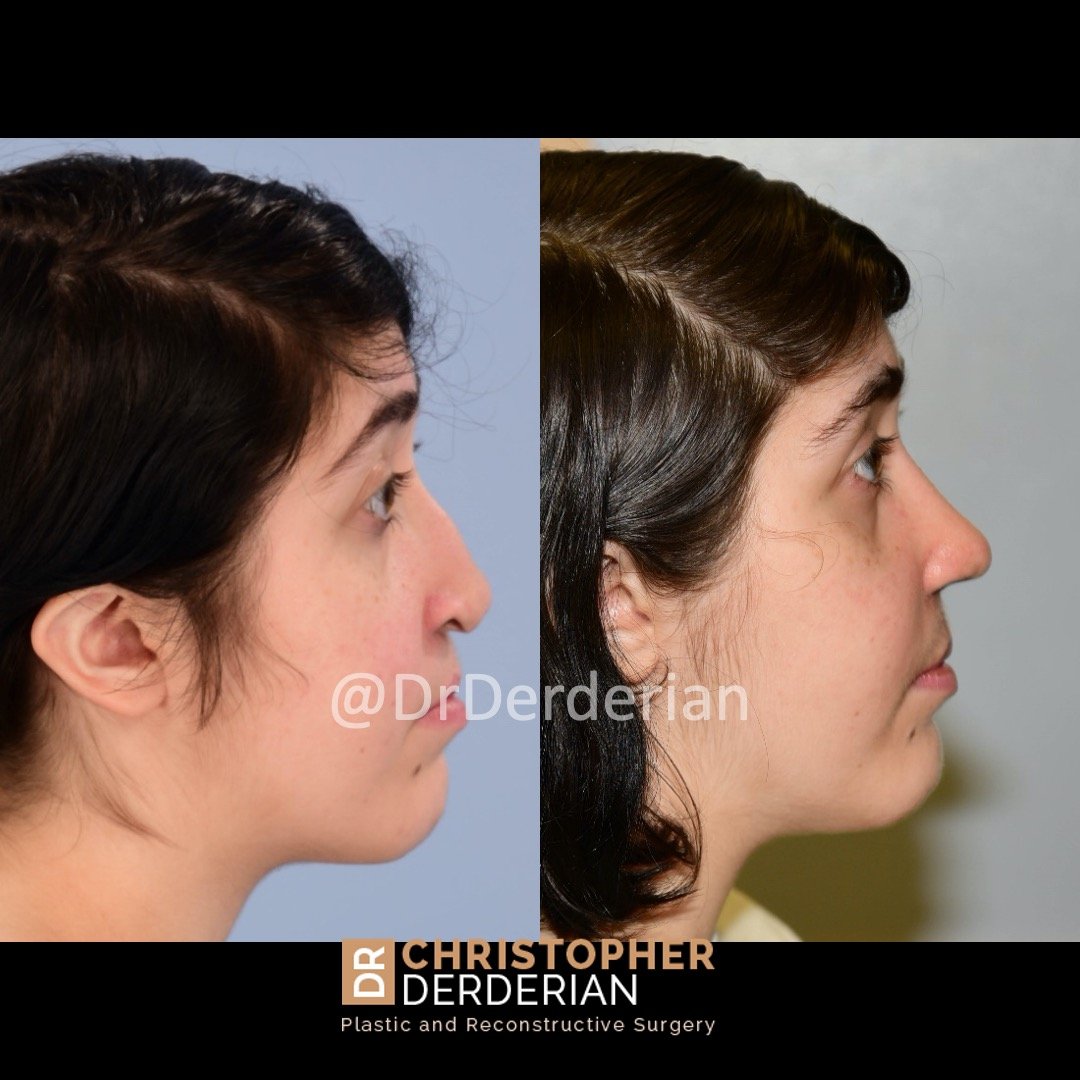 before and after cleft rhinoplasty and cleft lip revision case 16 right lateral