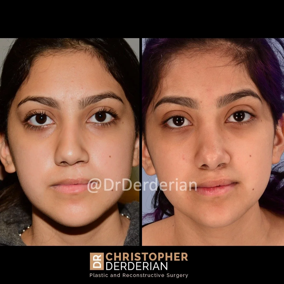 before and after cleft rhinoplasty upper lip fat grafting case 18 AP