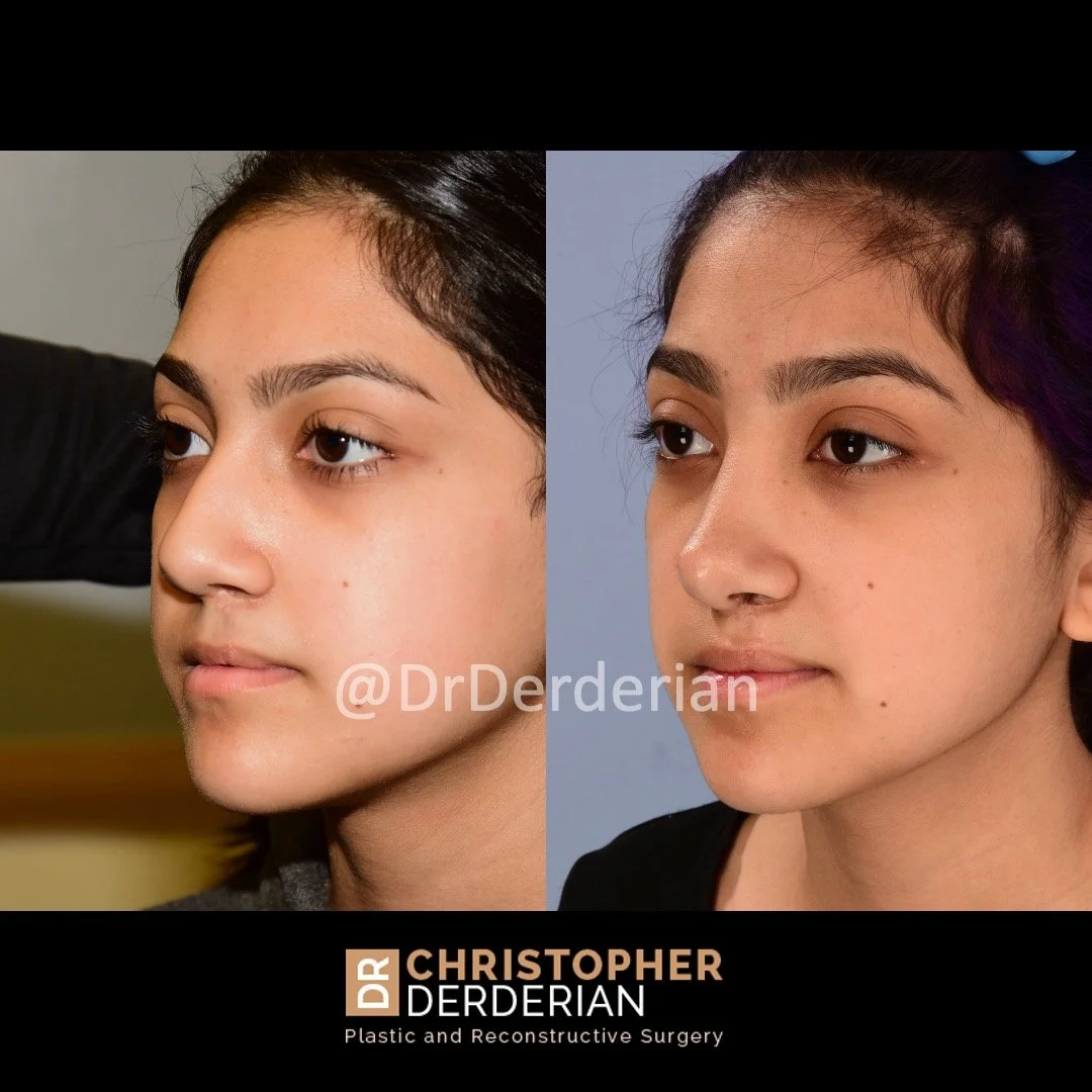 before and after cleft rhinoplasty upper lip fat grafting case 18 left 3/4