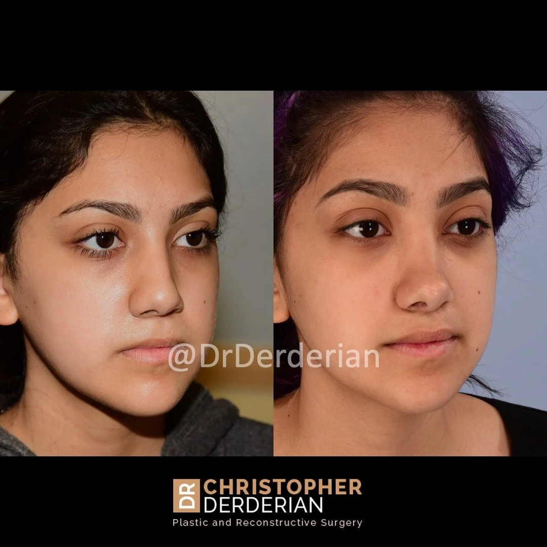 before and after cleft rhinoplasty upper lip fat grafting case 18 right 3/4