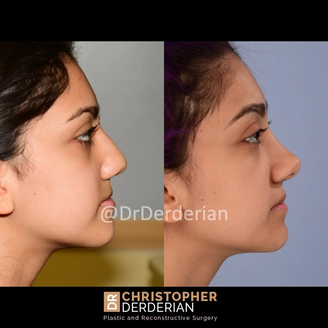 before and after cleft rhinoplasty upper lip fat grafting case 18 right lateral