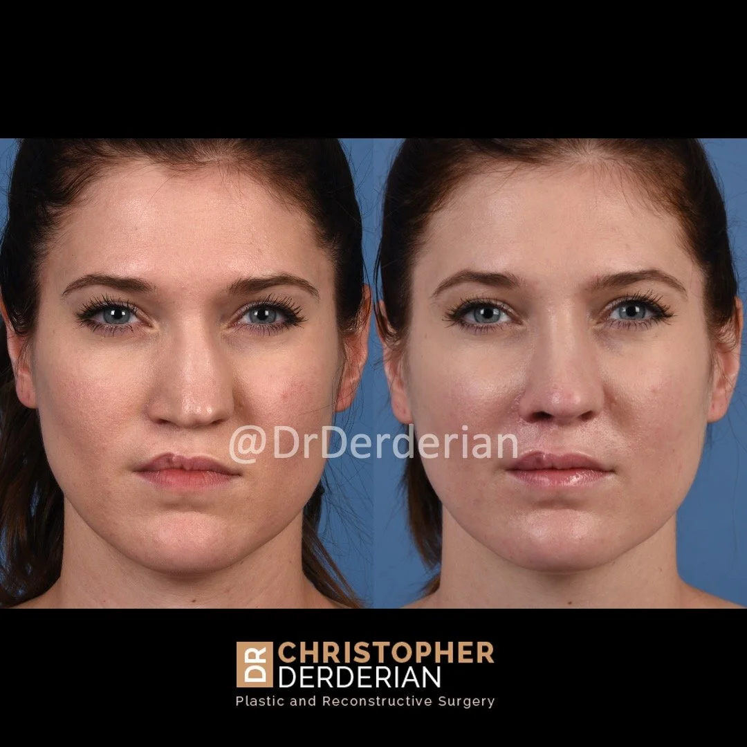 before and after cleft rhinoplasty upper lip fat grafting case 19 AP