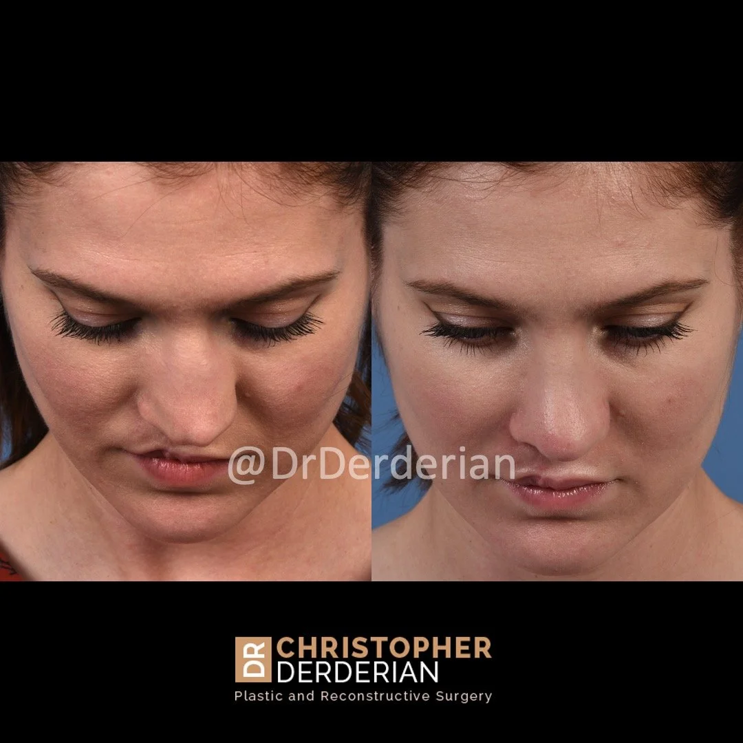 before and after cleft rhinoplasty upper lip fat grafting case 19 above