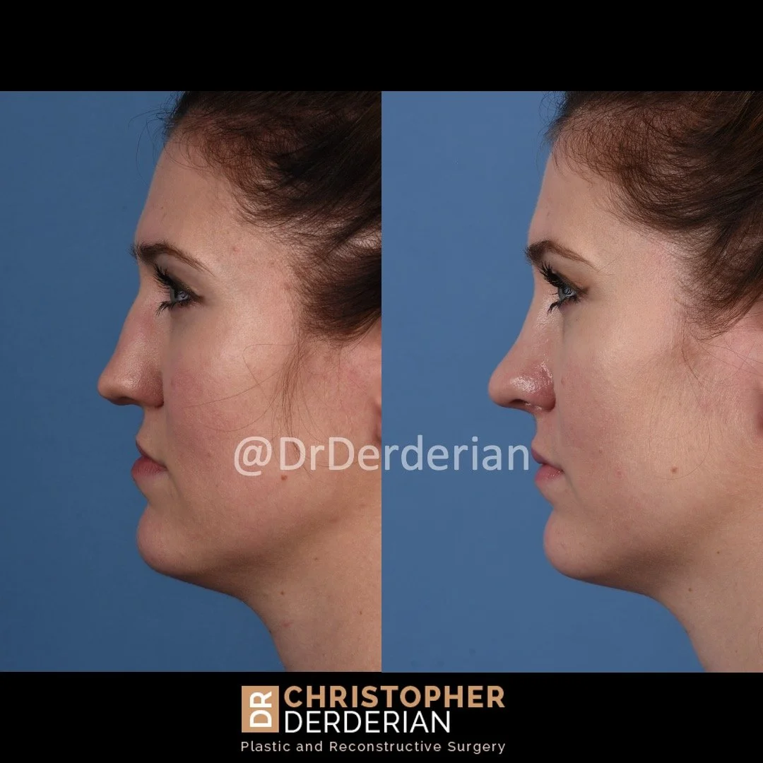 before and after cleft rhinoplasty upper lip fat grafting case 19 left lateral