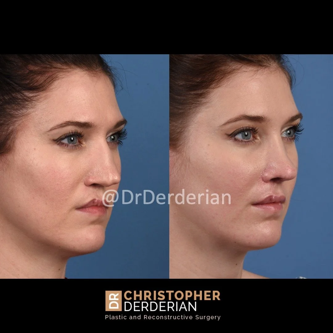 before and after cleft rhinoplasty upper lip fat grafting case 19 right 3/4
