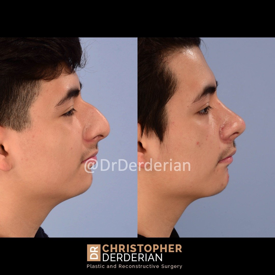 drderderian before and after rhinoplasty 2.18.22 right lateral.jpeg