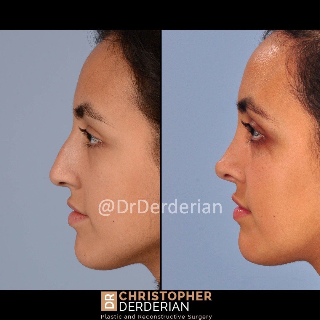 drderderian rhinoplasty before and after 8.22.23 left lateral.jpeg