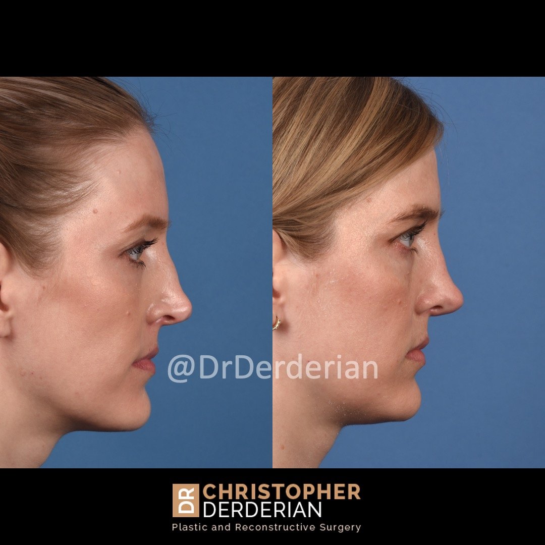 drderderian before and after rhinoplasty 6.3.21 1 year followup right lateral.jpeg