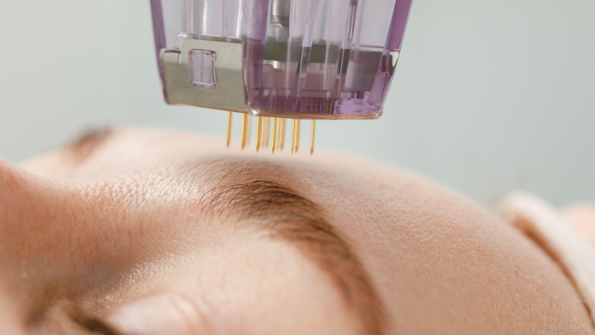 Tightening, Lifting, Smoothing: What Morpheus8 Really Does (and What It Doesn’t)