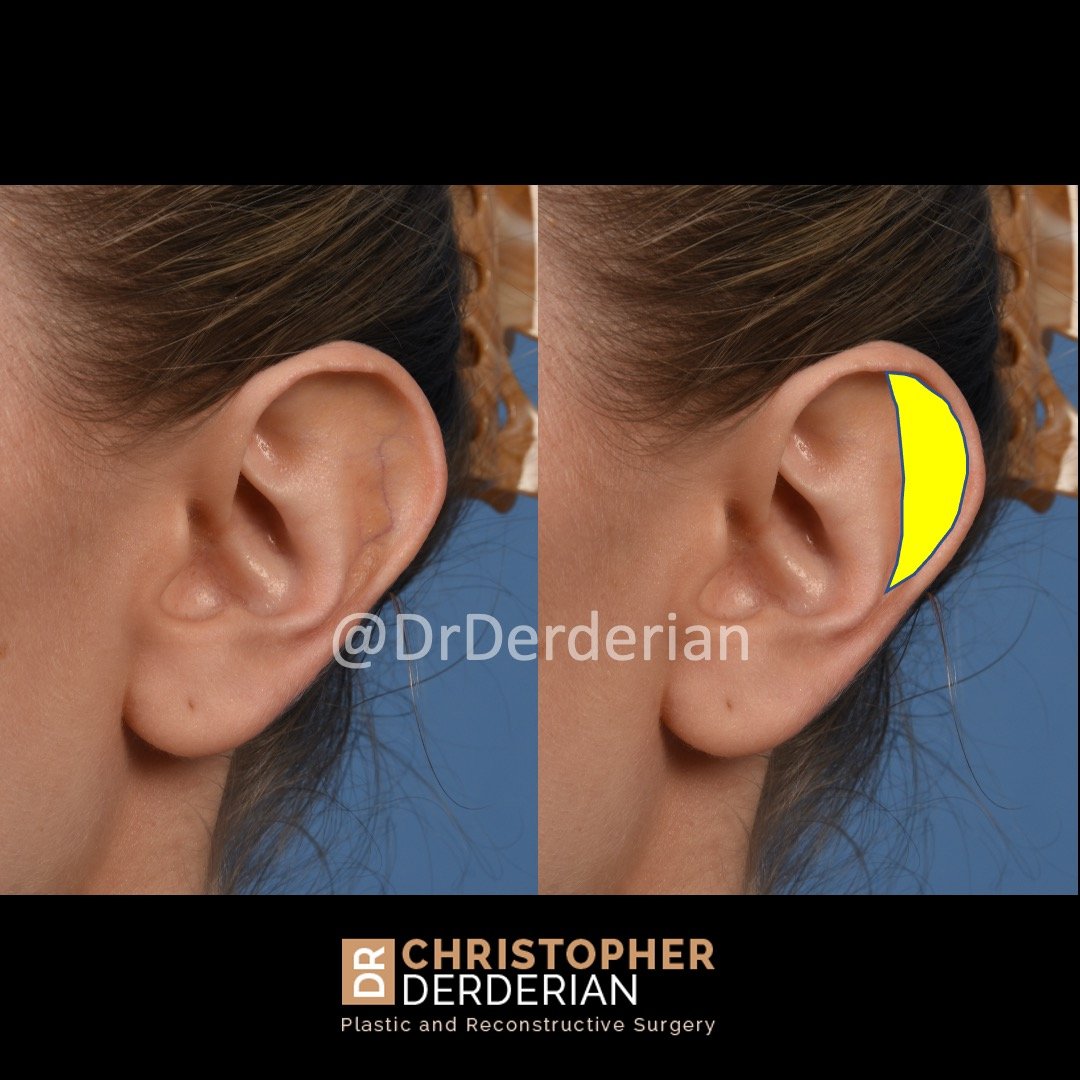 Protruding Ears Ear Pin Surgery Ear Reconstruction Ear Pinning
