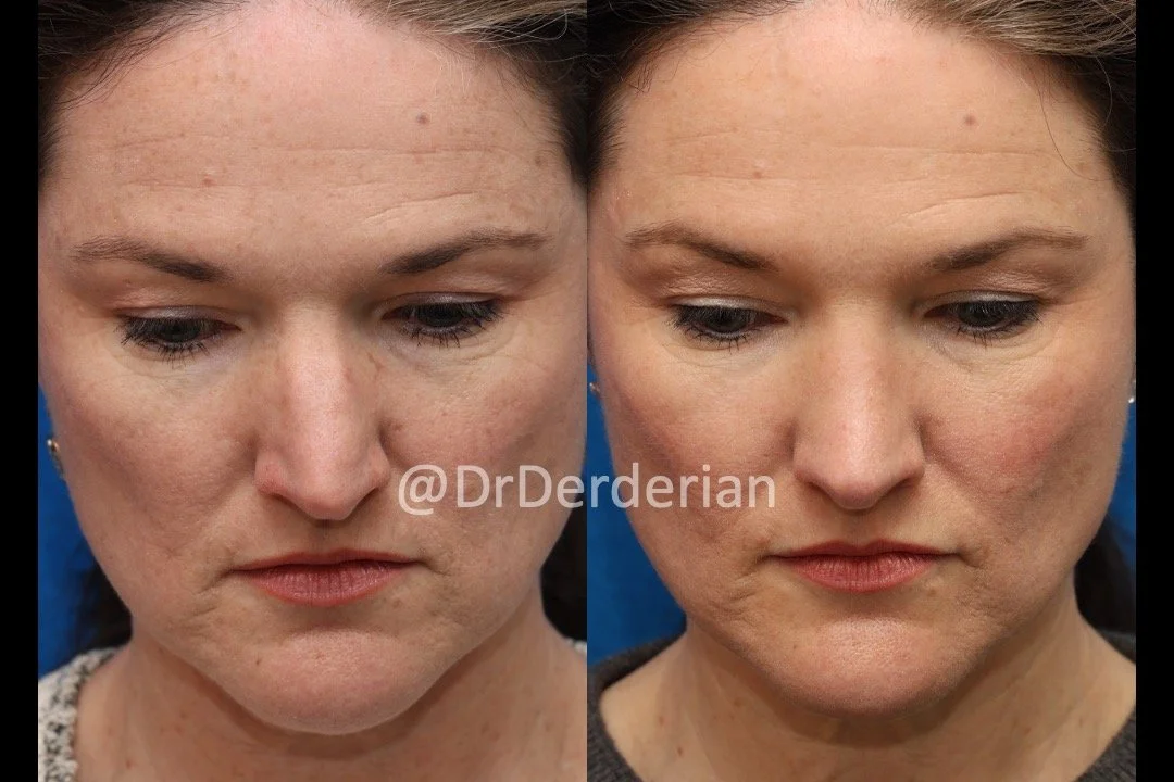 rhinoplasty before and after 2.12.25 above.jpeg