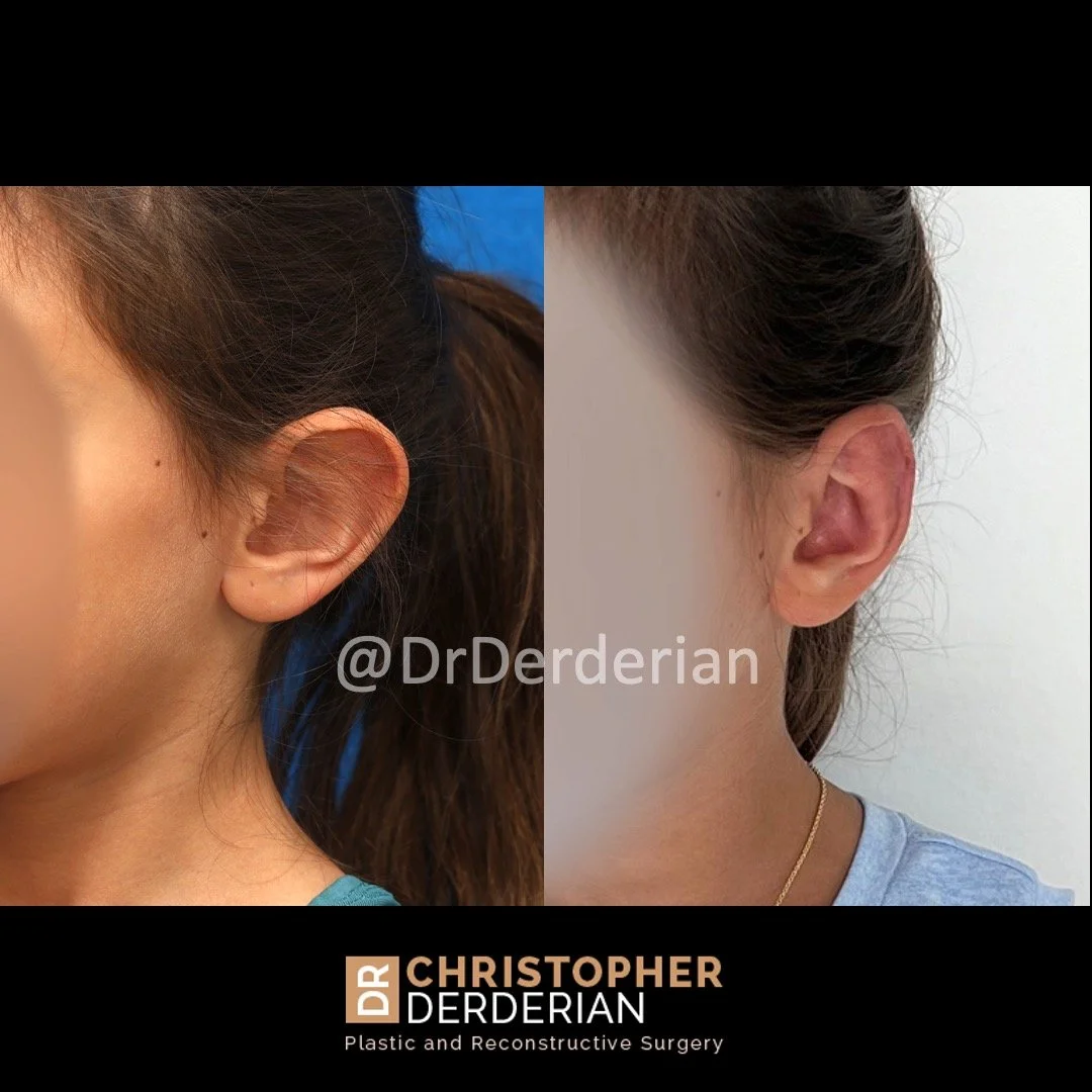 Before and after ear reduction and otoplasty left 3/4