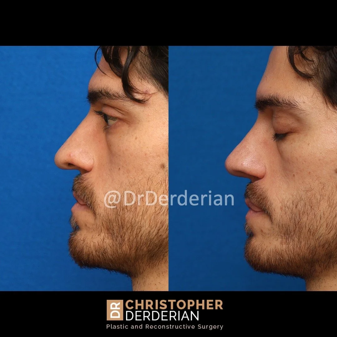 Before and after cleft rhinoplasty left lateral