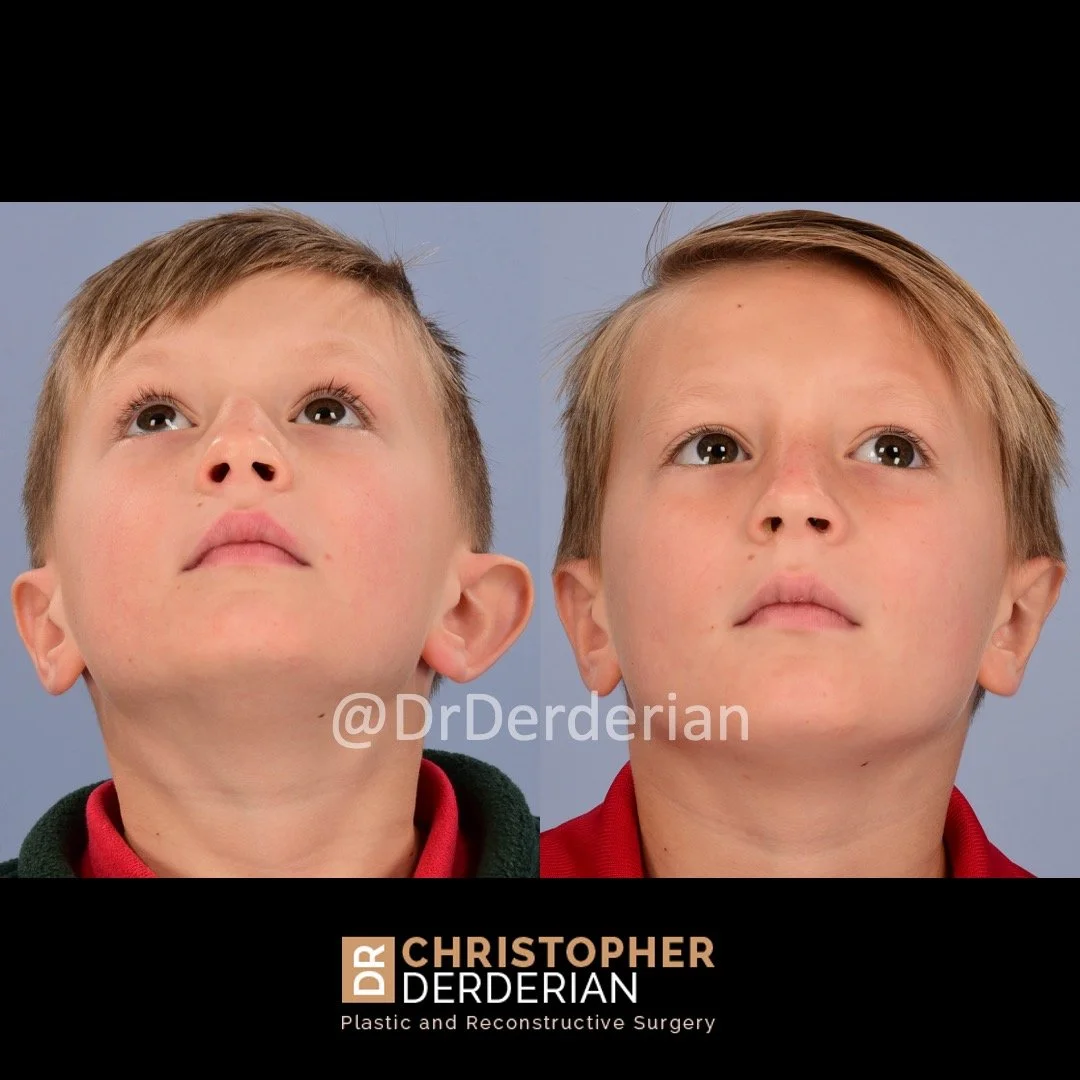 before and after otoplasty case 7 below view