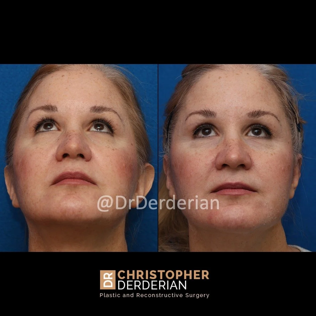 Before and after ear reduction surgery