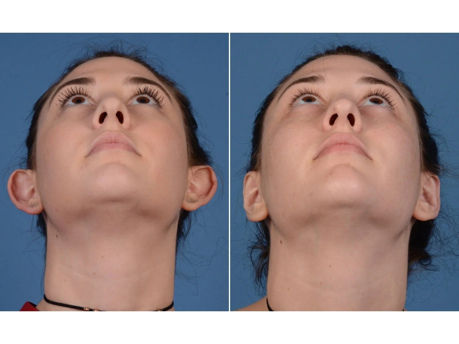 before and after otoplasty case 6 below view