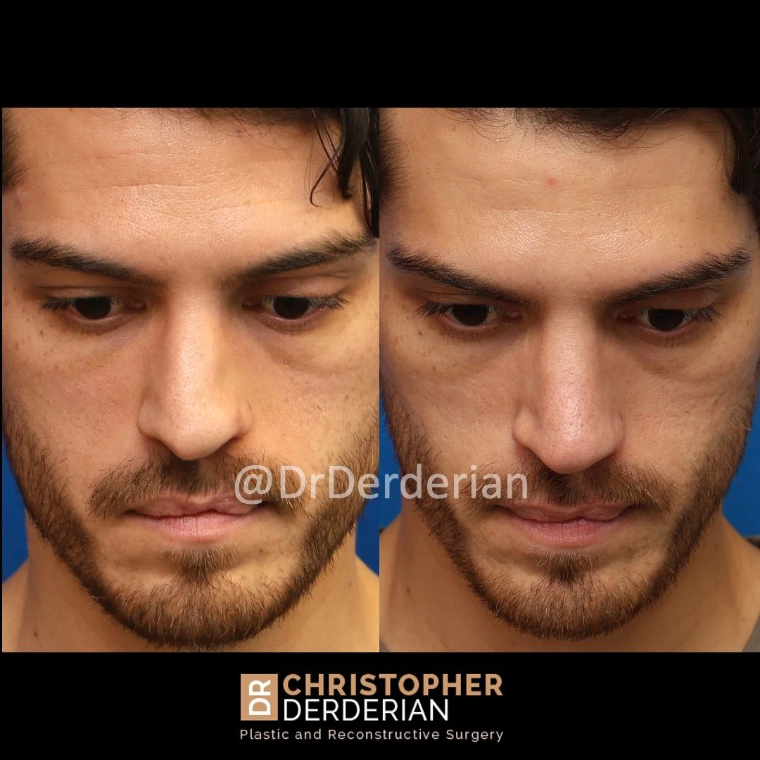 Before and after cleft rhinoplasty above view