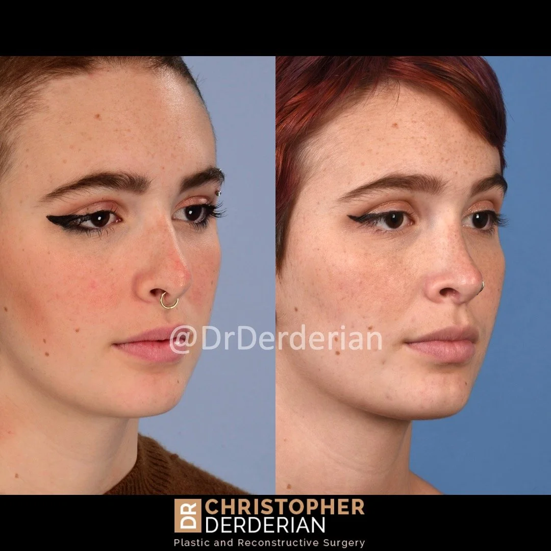 DrDerderian Rhinoplasty Before and After 10.1.2022 right 3:4.jpeg