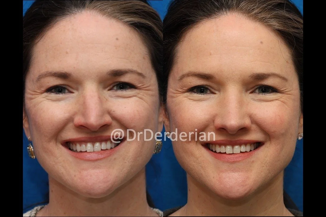 rhinoplasty before and after 2.12.25 AP smiling.jpeg