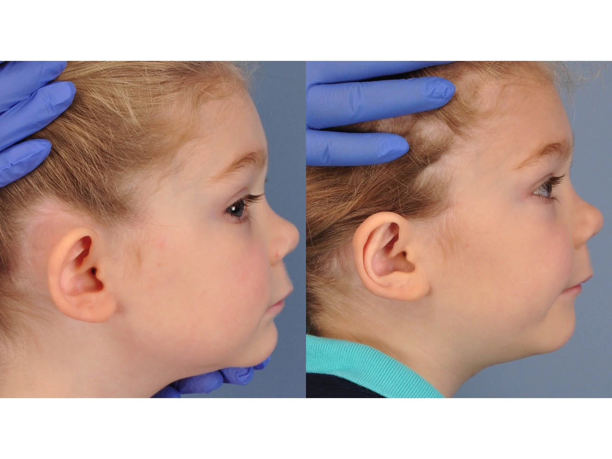 before and after otoplasty case 5 right lateral