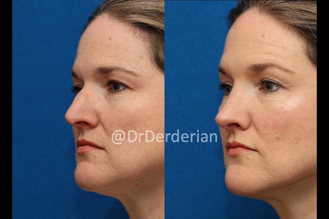 rhinoplasty before and after 2.12.25 left 3:4.jpeg
