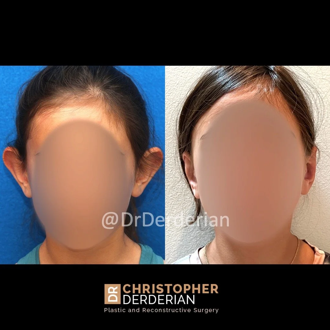 Before and after ear reduction + otoplasty front view