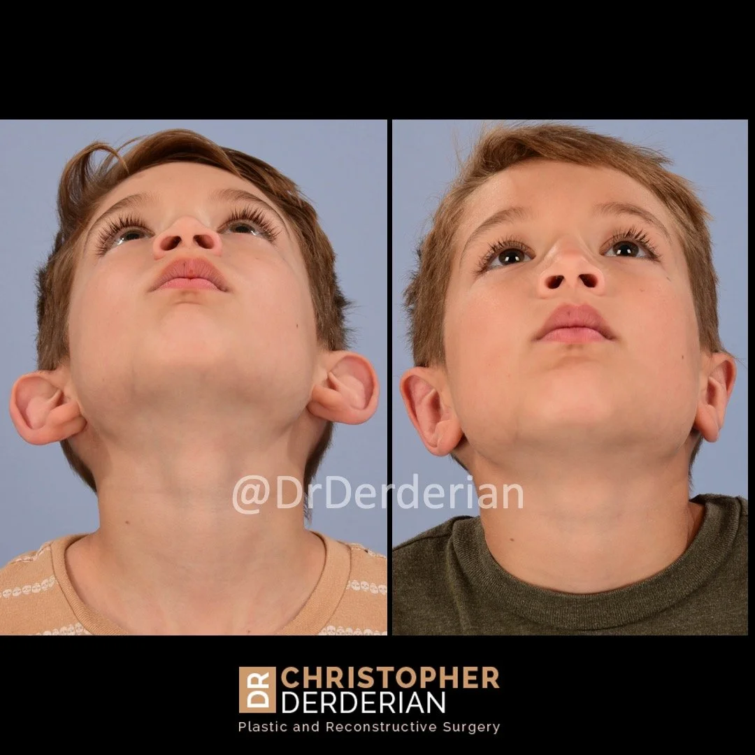 before and after otoplasty case 9 below view