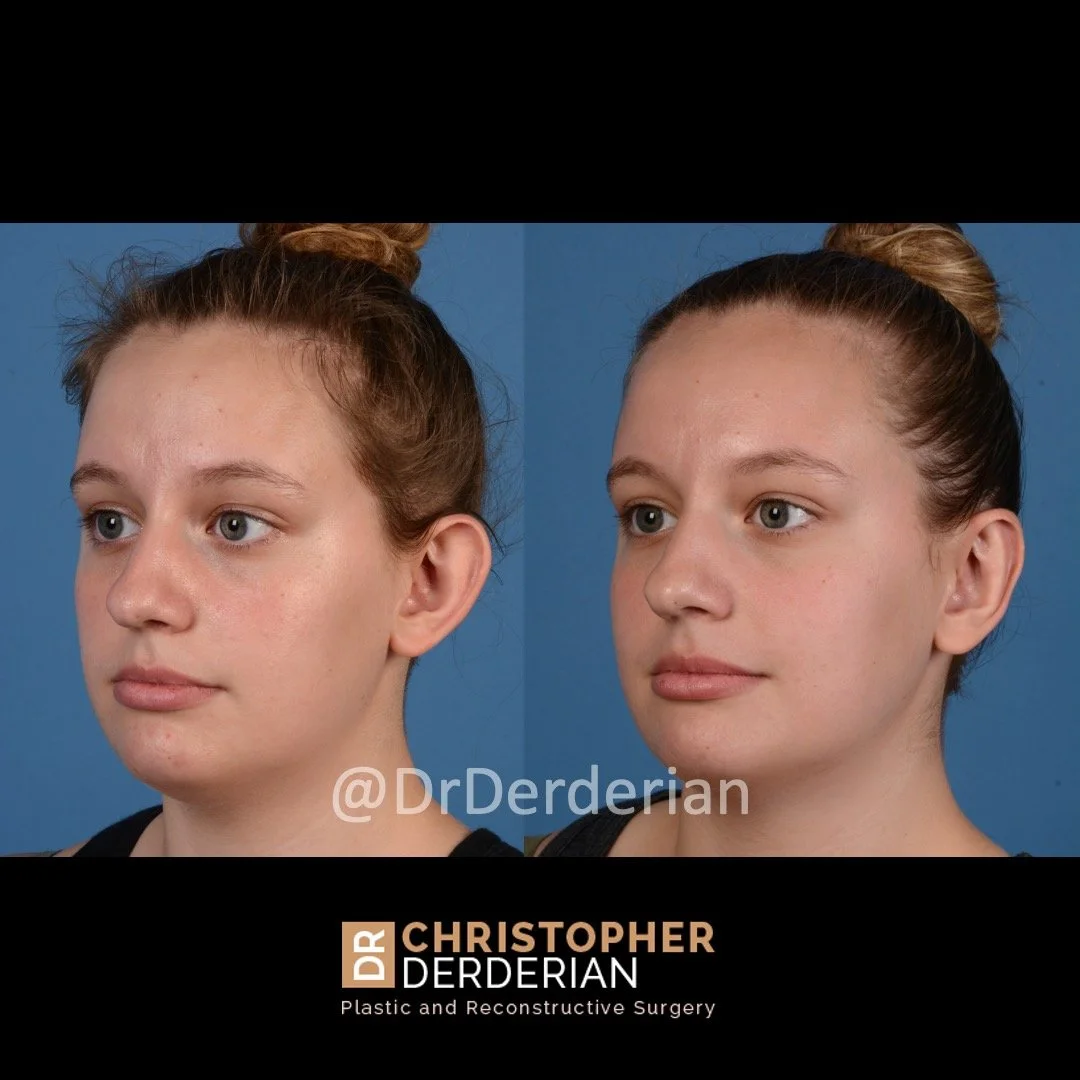 otoplasty before and after case 2 left 3/4