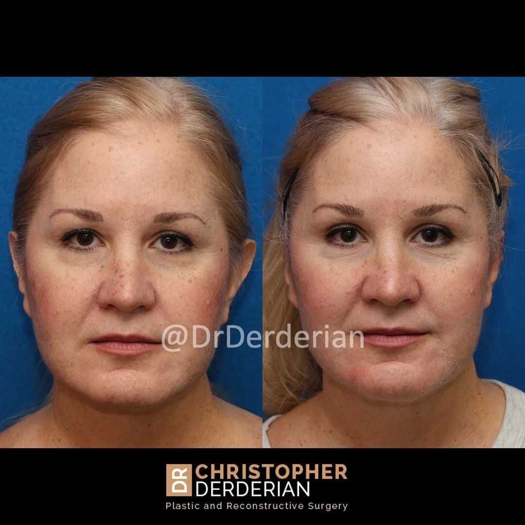 Before and after ear reduction surgery