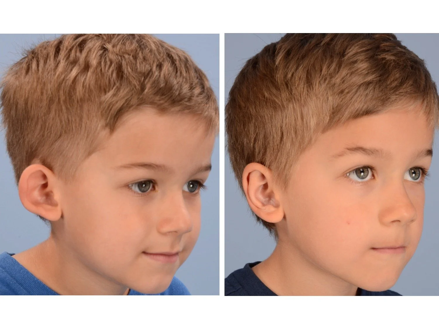 otoplasty before and after case 1 right 3/4