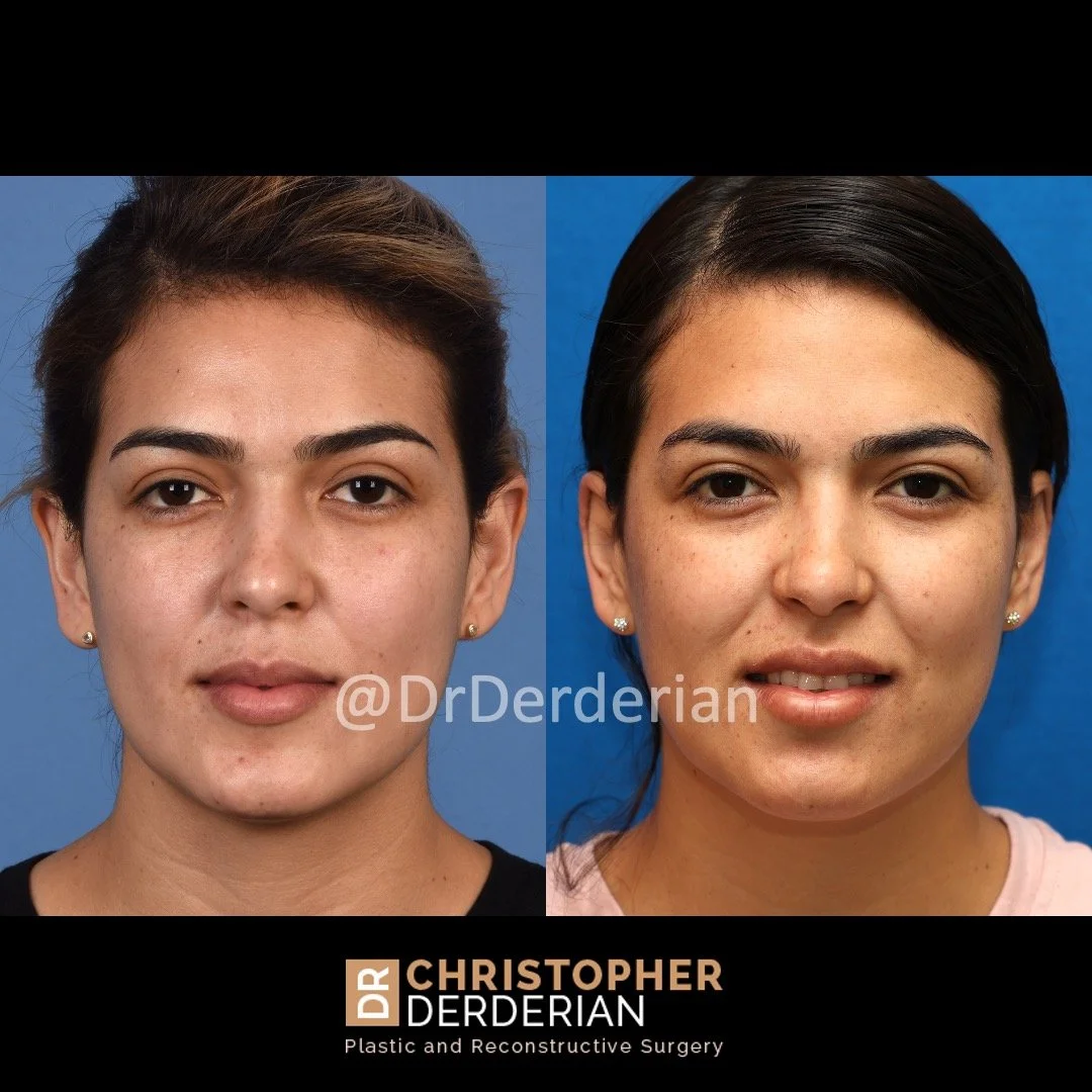 before and after ear reduction, reduction otoplasty front view