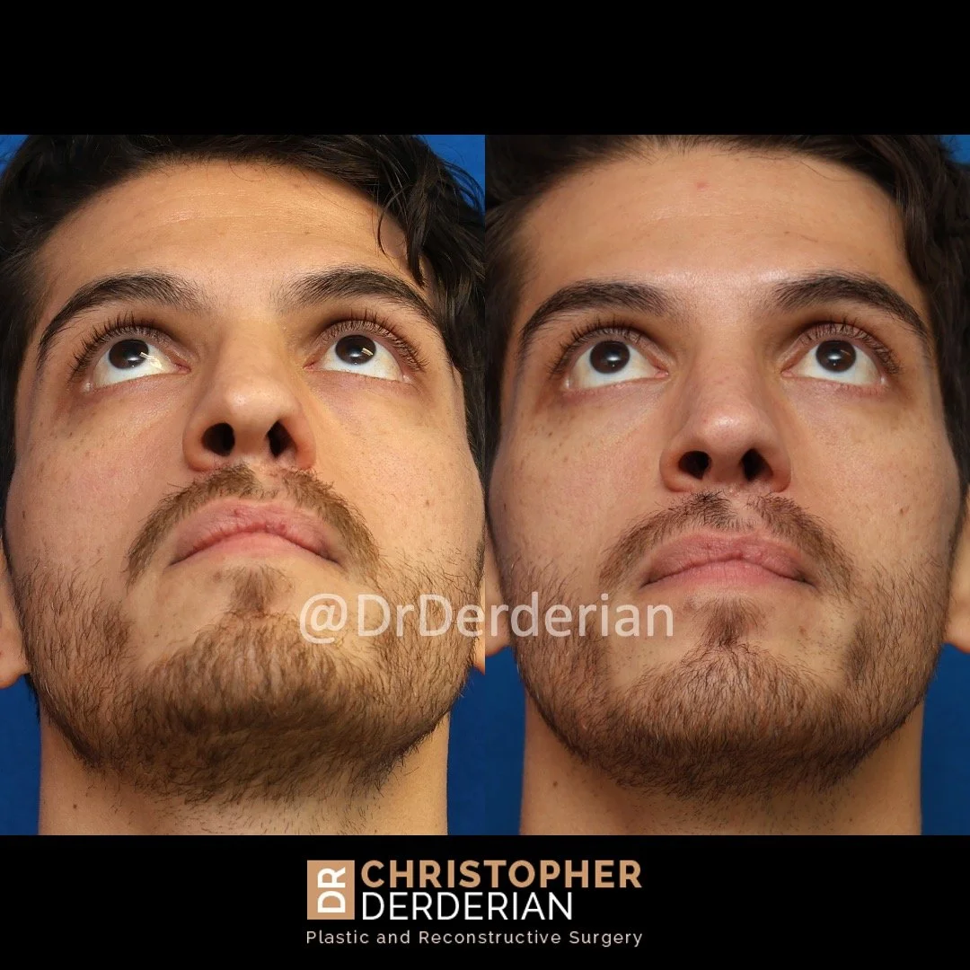 Before and after cleft rhinoplasty below view