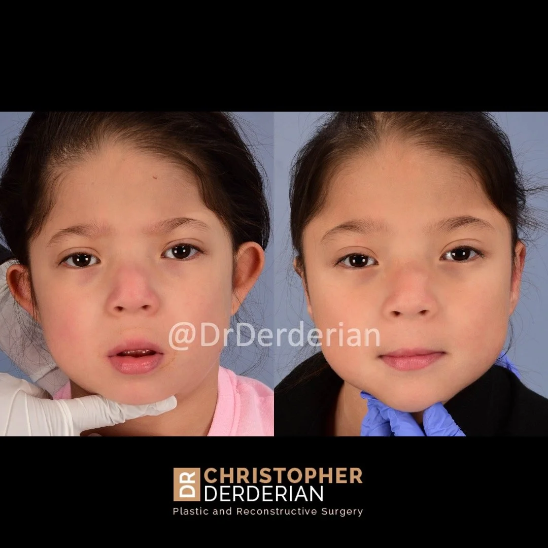 before and after otoplasty case 8 AP