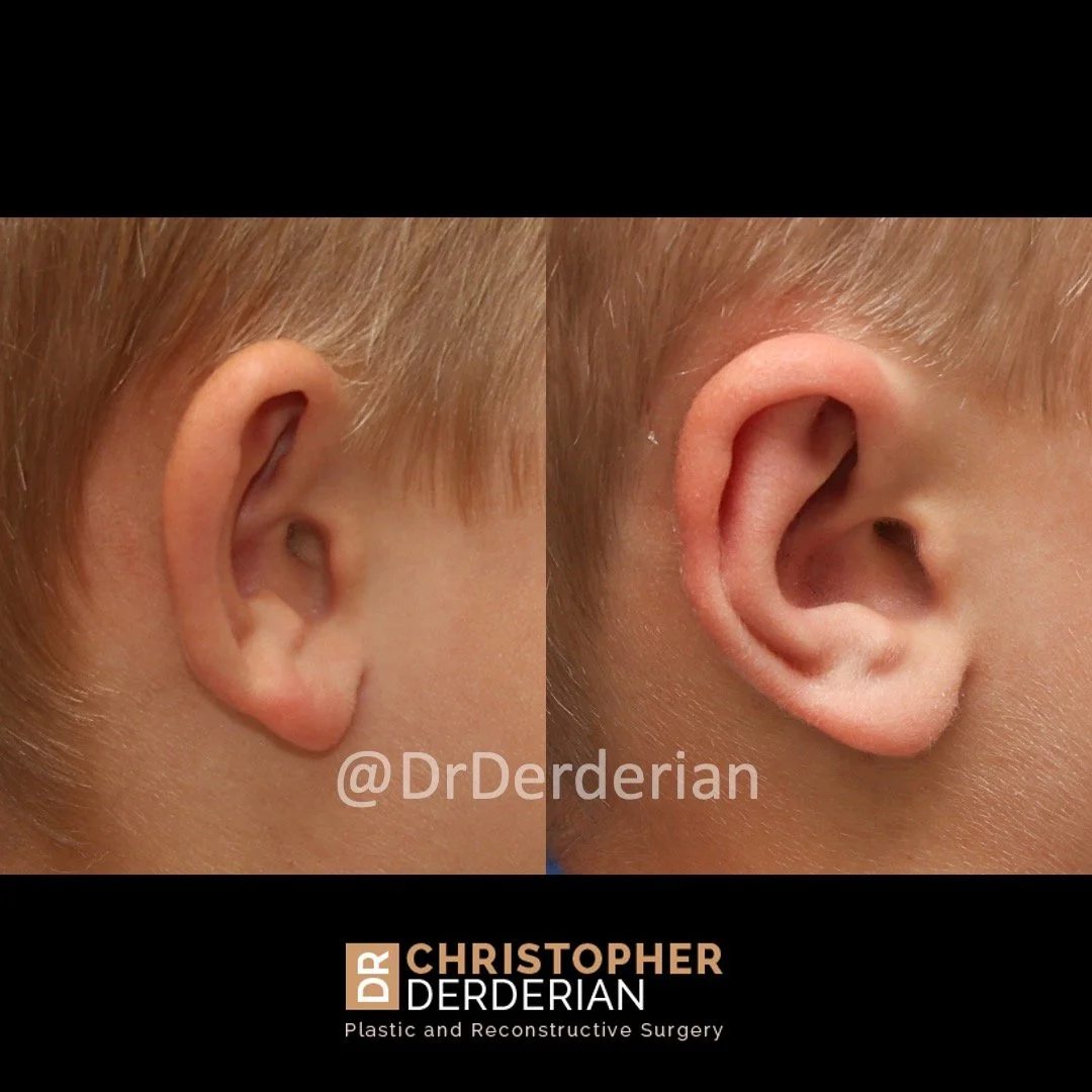 before and after photo otoplasty right view