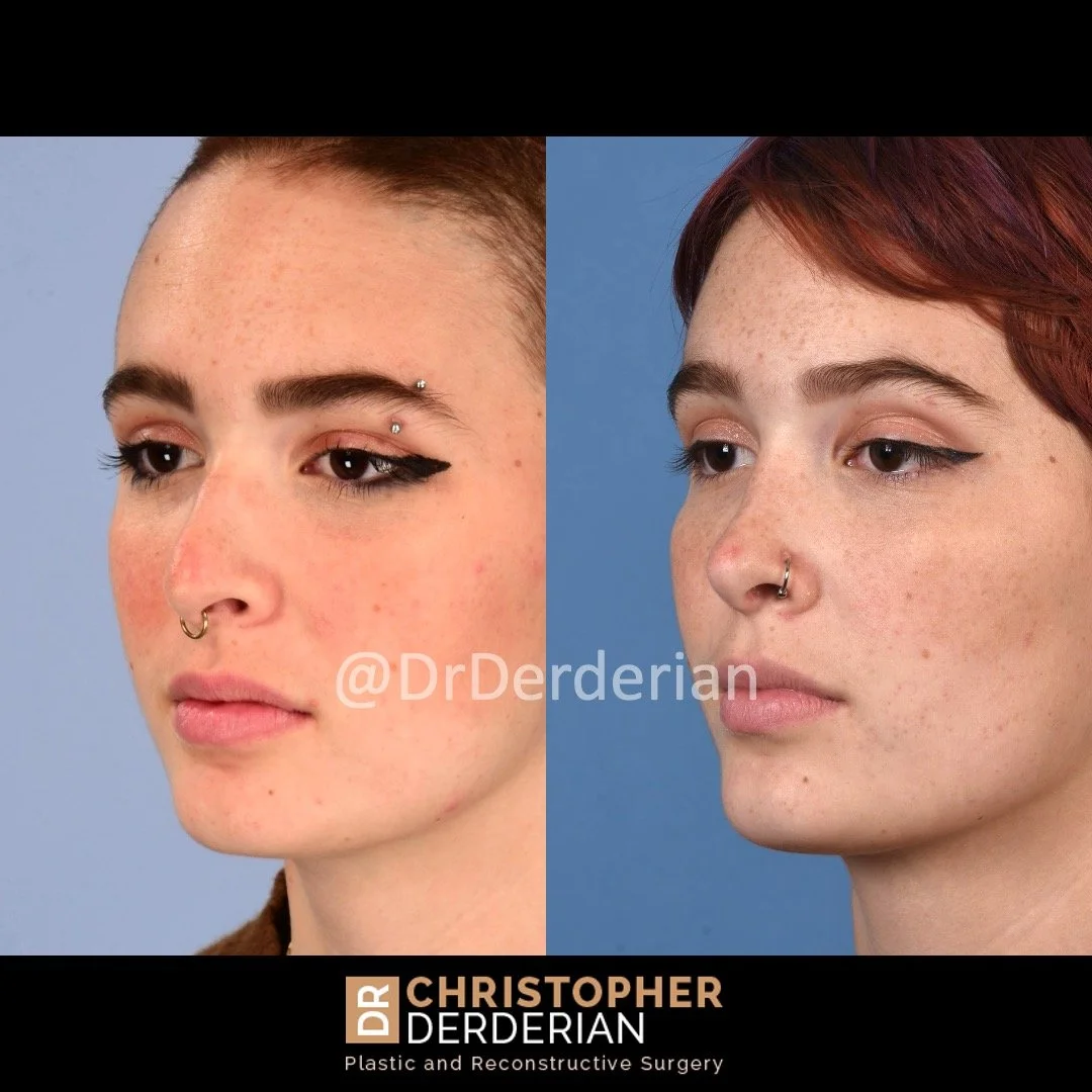 DrDerderian Rhinoplasty Before and After 10.1.2022 left 3:4.jpeg