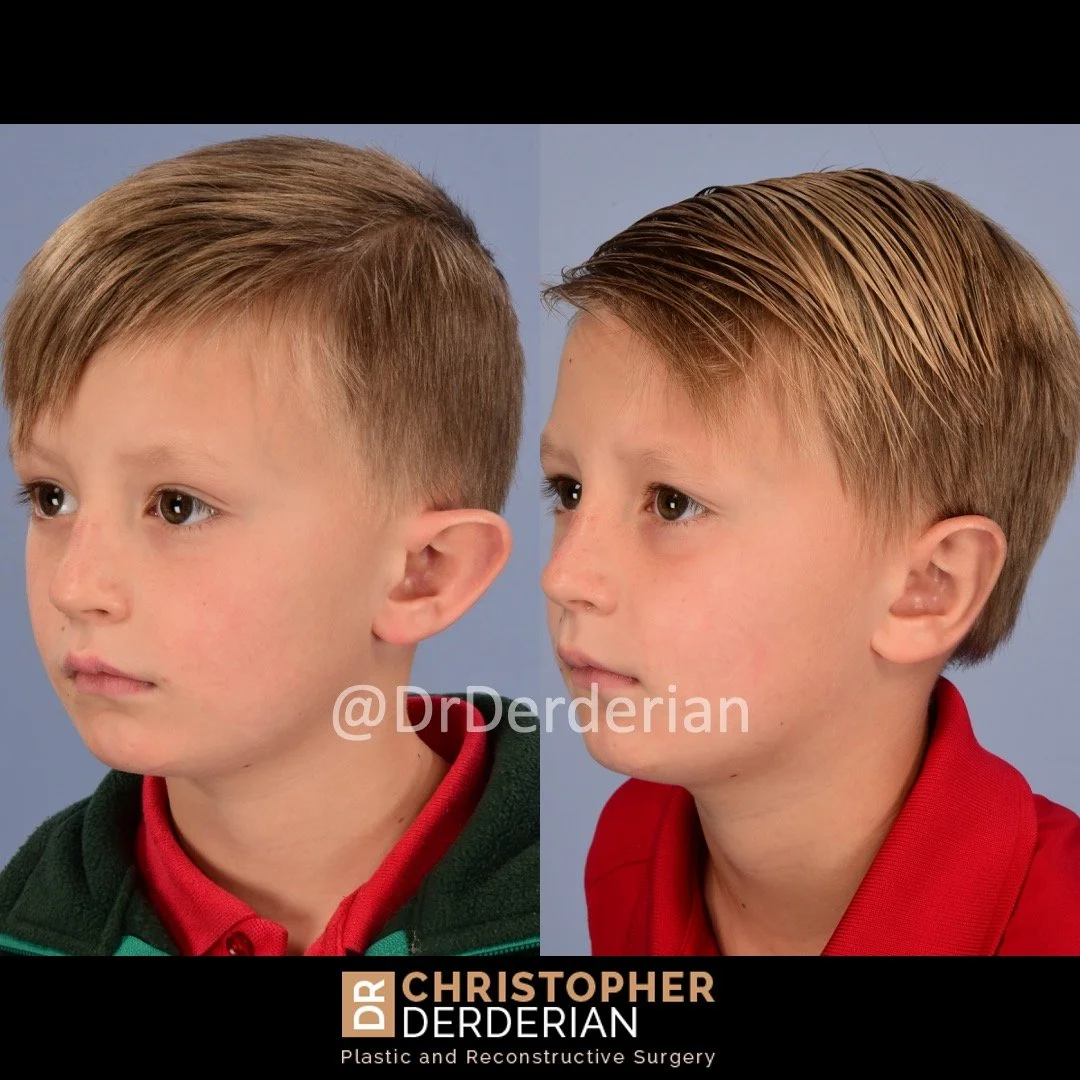 before and after otoplasty case 7 Left 3/4