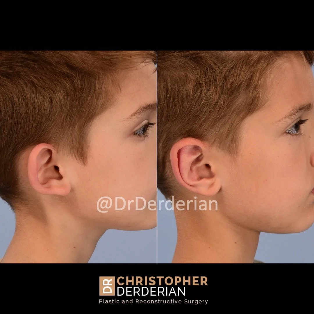 before and after otoplasty case 9 right lateral