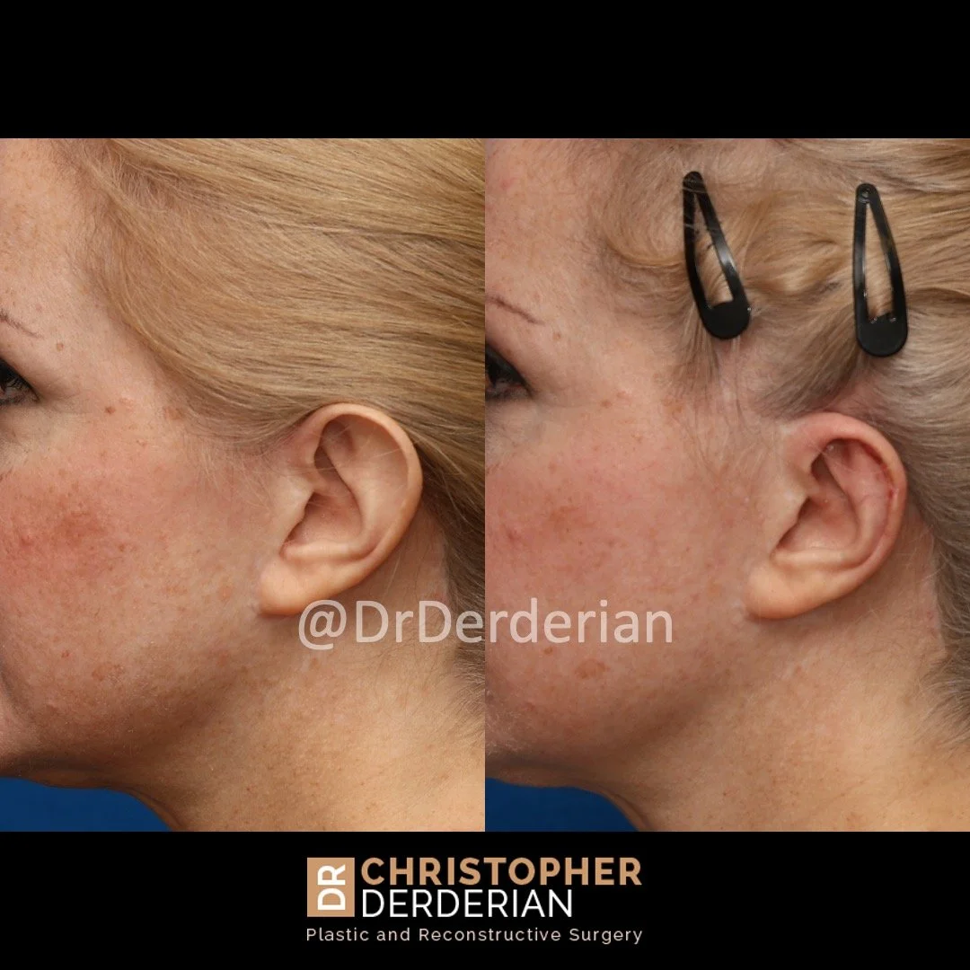 Before and after ear reduction surgery