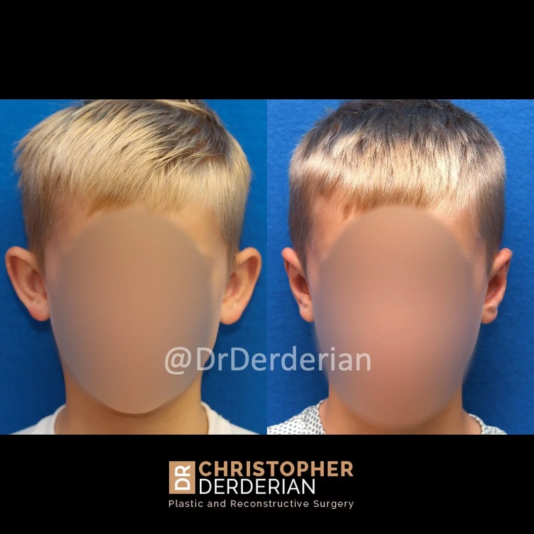 before and after photo otoplasty front view