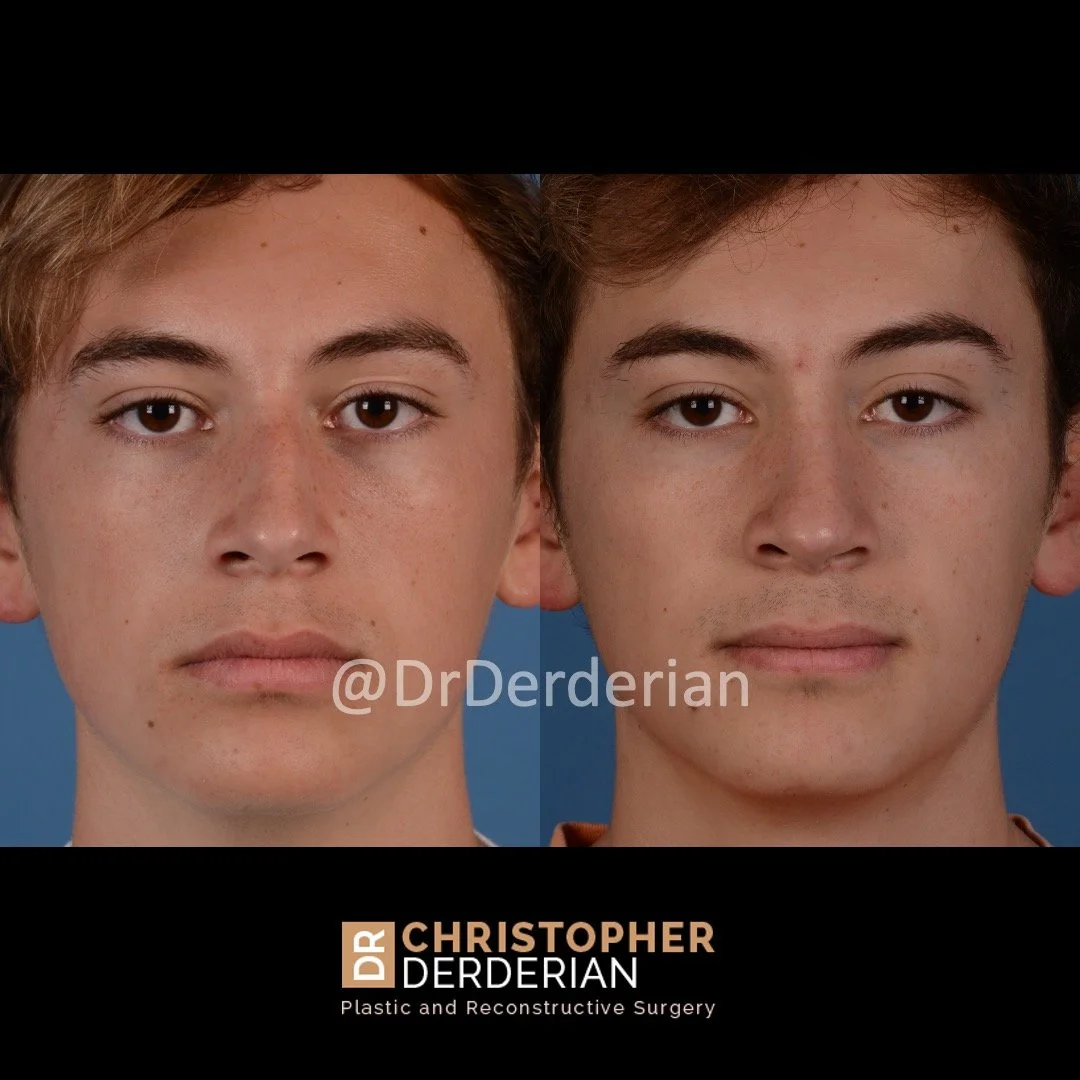 Demurring Septoplasty: Practice Essentials, History Of The Procedure – MAMOC