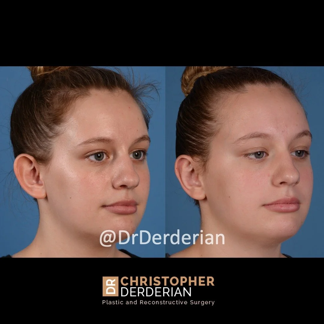 otoplasty before and after case 2 right 3/4
