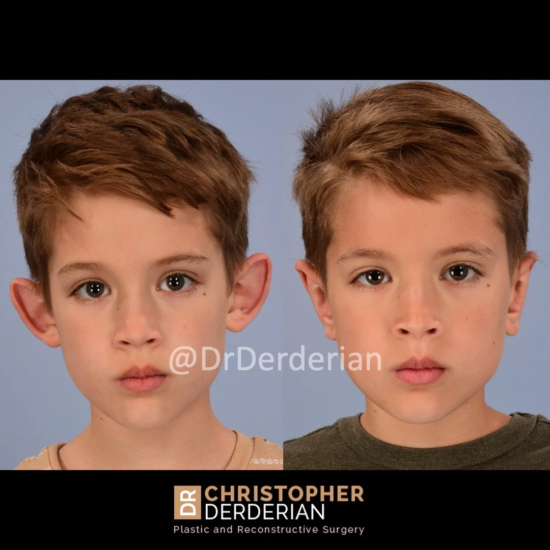 before and after otoplasty case 9 AP