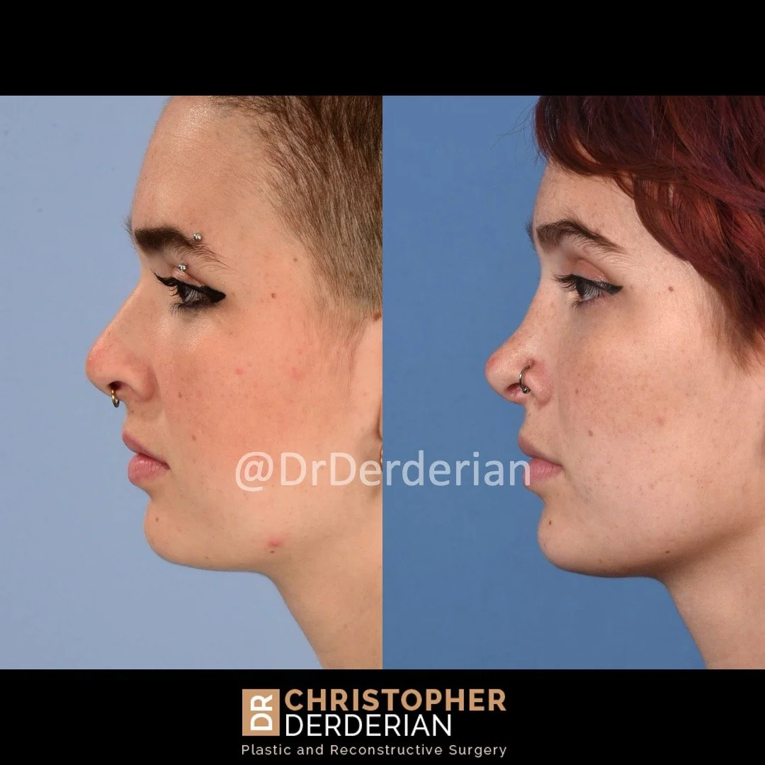 DrDerderian Rhinoplasty Before and After 10.1.2022 left.jpeg