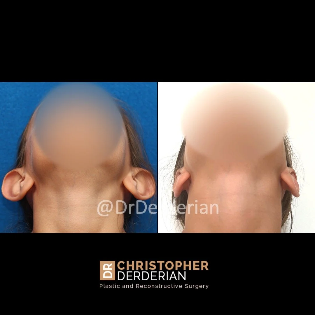 Before and after ear reduction + otoplasty below view