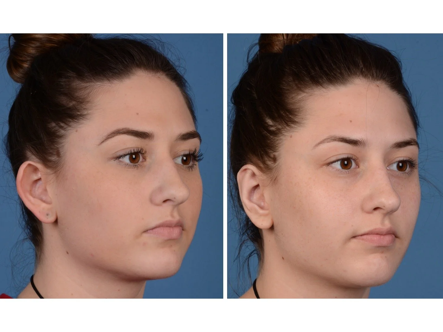 before and after otoplasty case 6 right 3/4
